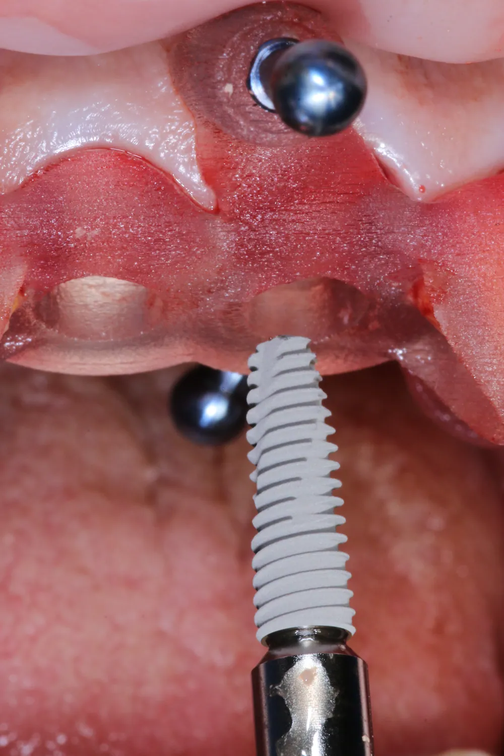 Inserarea unui implant prin ghid