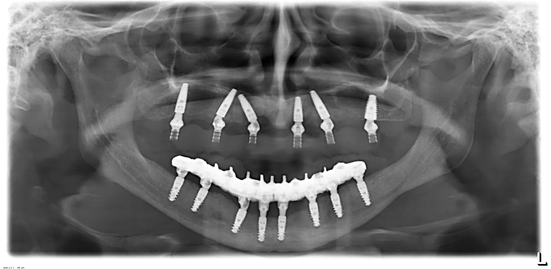 Radiografie panoramică după inserarea implanturilor