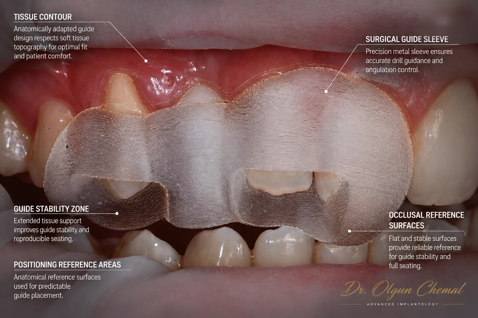 Ghid chirurgical pentru implant dentar, poziționat pe arcadă, vedere frontală
