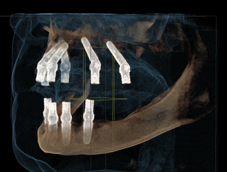 Planificare digitală pe CBCT a poziției implanturilor pentru o lucrare fixă pe arcadă completă