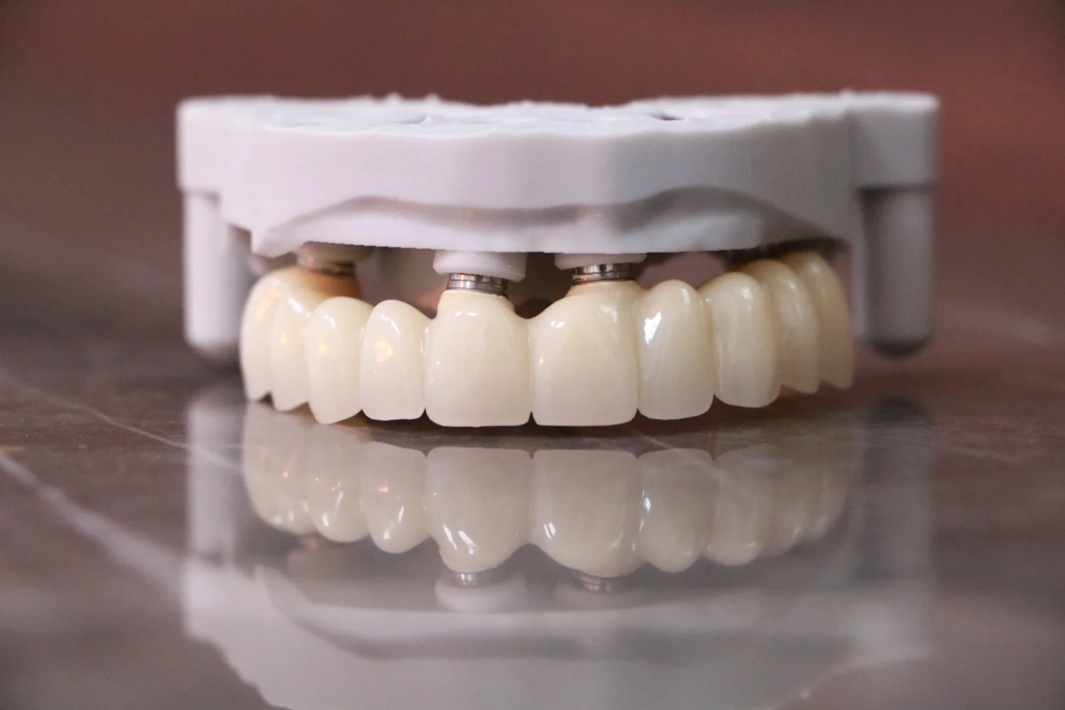 Lucrare provizorie din PMMA pe model, cu bonturi multi-unit