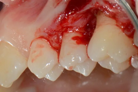 Chiuretaj în câmp deschis la molarul 1.6: lamboul gingival ridicat