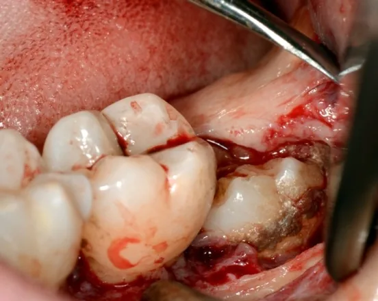 Extracția unui molar de minte care favoriza reținerea plăcii bacteriene