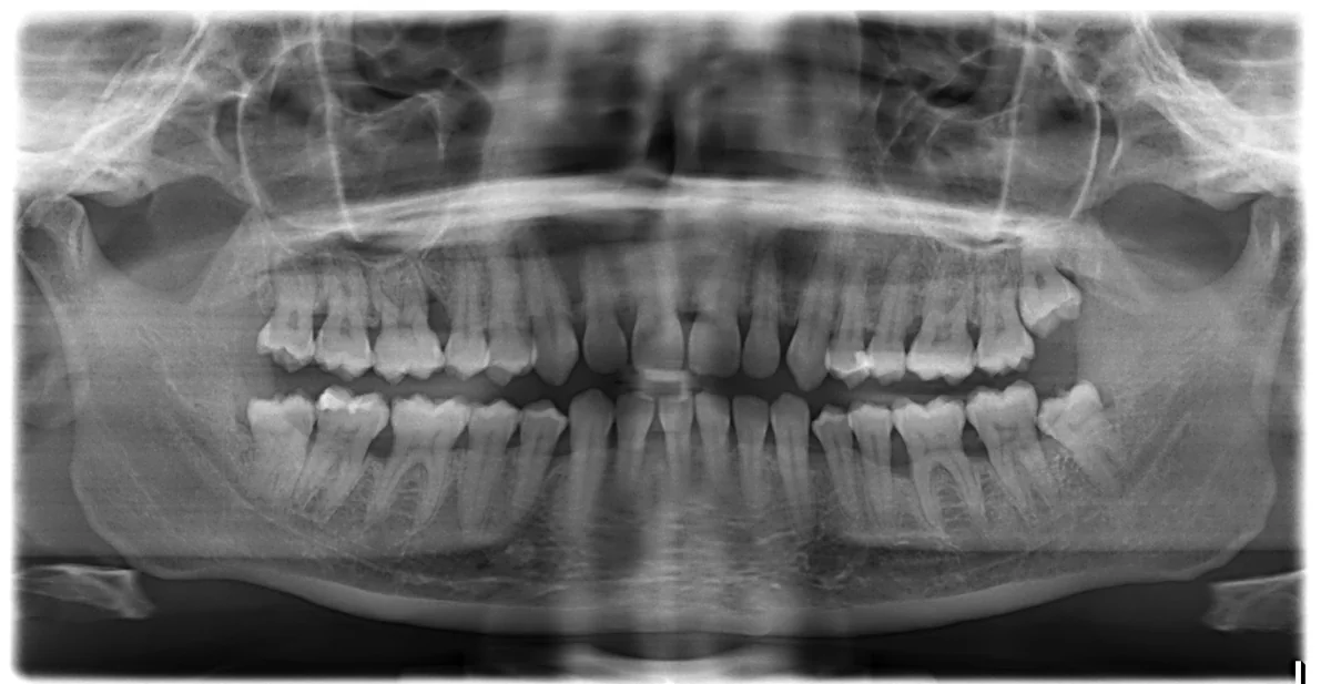 Radiografie panoramică inițială, 2014: pierdere osoasă în jurul dinților, în special la molari și la incisivii inferiori; molari de minte care rețin placa bacteriană