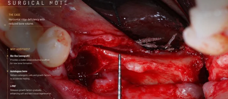 Defect osos mandibular evaluat intraoperator, înainte de regenerare
