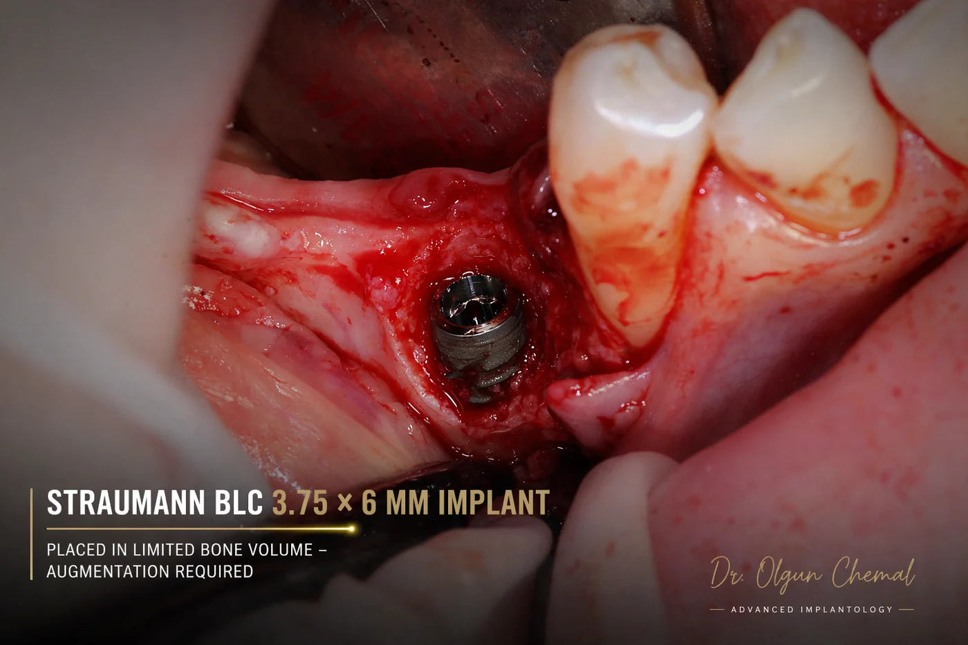 Straumann BLC 3,75 x 6 mm inserat într-un volum osos limitat, urmat de augmentare