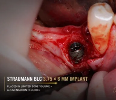 Implant scurt Straumann BLC 3,75 x 6 mm inserat în os cu înălțime redusă