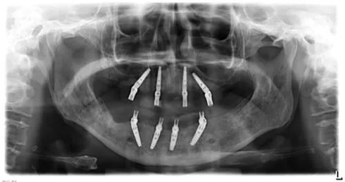 Radiografie panoramică cu implanturi dentare, caz 5
