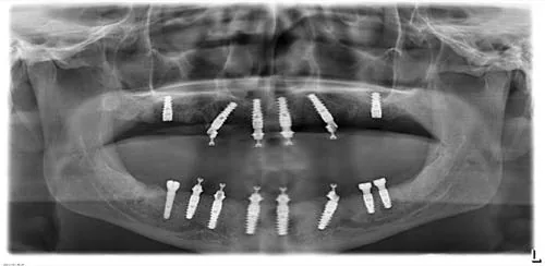 Radiografie panoramică cu implanturi dentare, caz 8