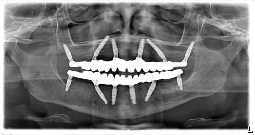 Radiografie panoramică cu implanturi dentare, caz 10