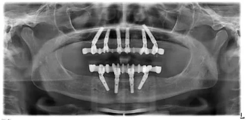 Radiografie panoramică cu implanturi dentare, caz 14