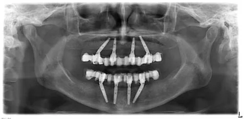Radiografie panoramică cu implanturi dentare, caz 15