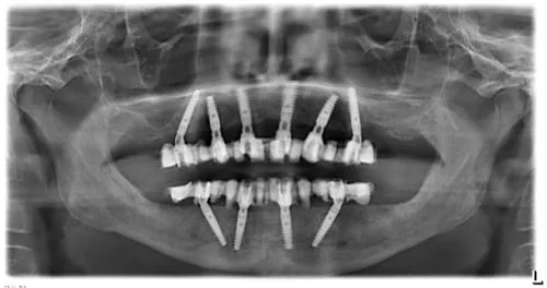 Radiografie panoramică cu implanturi dentare, caz 19