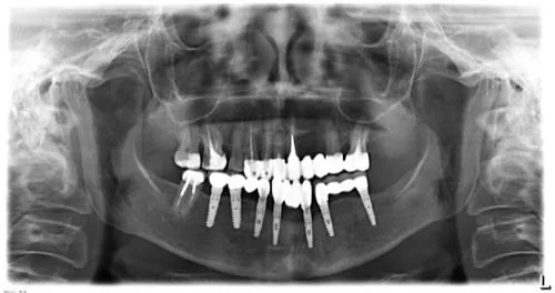 Radiografie panoramică cu implanturi dentare, caz 29