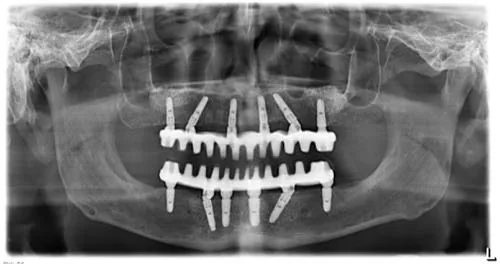 Radiografie panoramică cu implanturi dentare, caz 35