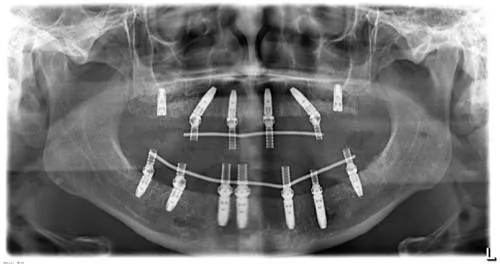 Radiografie panoramică cu implanturi dentare, caz 38