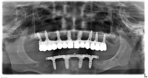 Radiografie panoramică cu implanturi dentare, caz 39