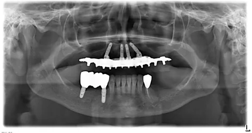Radiografie panoramică cu implanturi dentare, caz 1