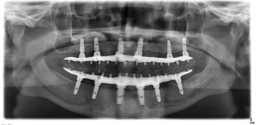 Radiografie panoramică cu implanturi dentare, caz 11