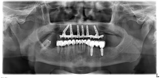 Radiografie panoramică cu implanturi dentare, caz 17