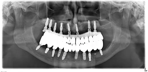Radiografie panoramică cu implanturi dentare, caz 21