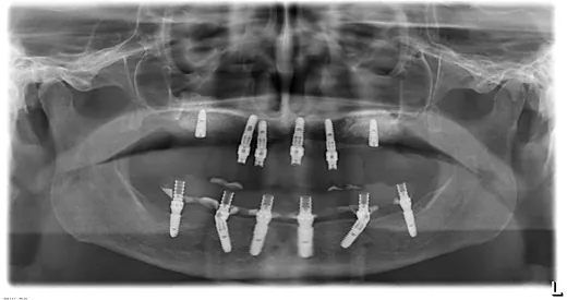 Radiografie panoramică cu implanturi dentare, caz 22