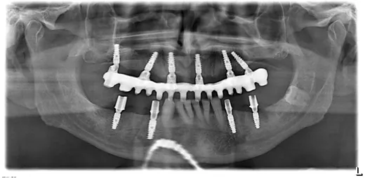 Radiografie panoramică cu implanturi dentare, caz 31
