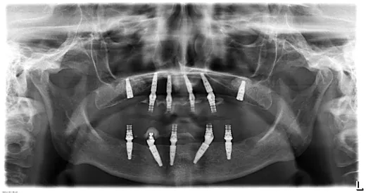 Radiografie panoramică cu implanturi dentare, caz 32