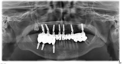 Radiografie panoramică cu implanturi dentare, caz 36