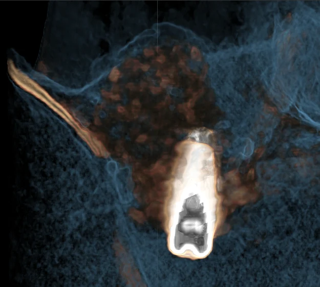 Sinus lift maxilar și implant dentar — caz clinic Dr. Olgun Chemal Constanța