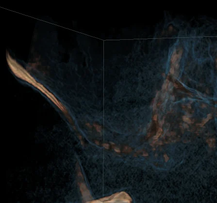 CBCT înainte de sinus lift cu volum osos rezidual redus — caz Dr. Olgun Chemal, Constanța