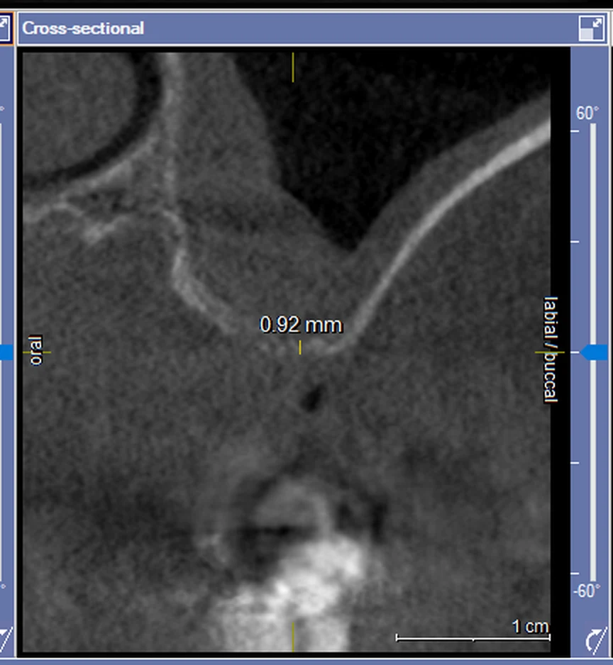 Măsurătoare CBCT: aproximativ 0,9 mm os rezidual sub sinusul maxilar
