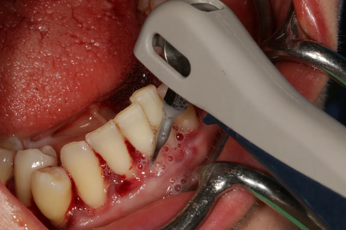 Instrument Vector Paro introdus în punga parodontală, imagine clinică macro